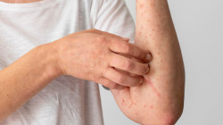 Así se contagia Mpox, conocida como viruela del mono: no se necesitan encuentros íntimos