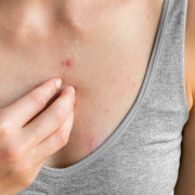 Entienda la viruela del mono y cuídese del contagio